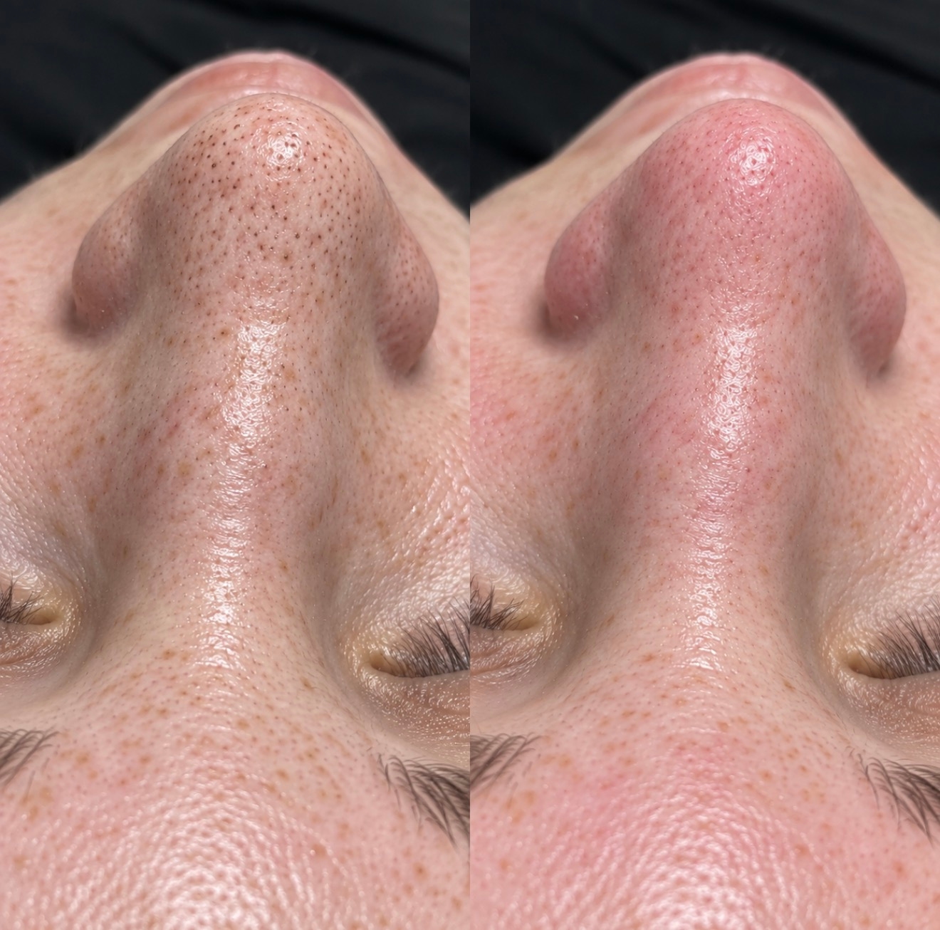 Чистка HydraFacial и пилинг