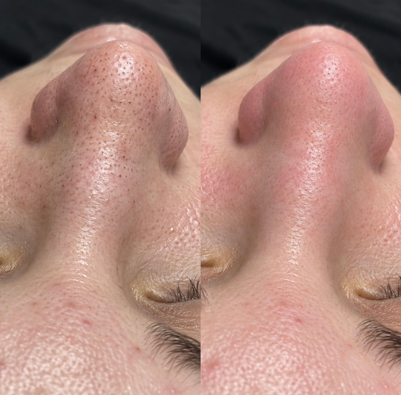 Чистка HydraFacial и пилинг